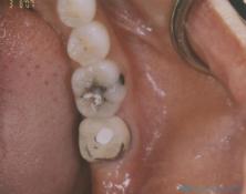 Pre-Operative for a Crown and Filling