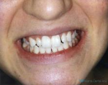 Veneers 