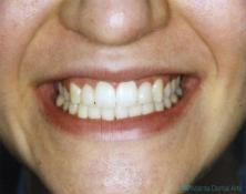 Veneers 