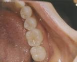 Posterior Fillings