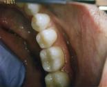 Posterior Fillings